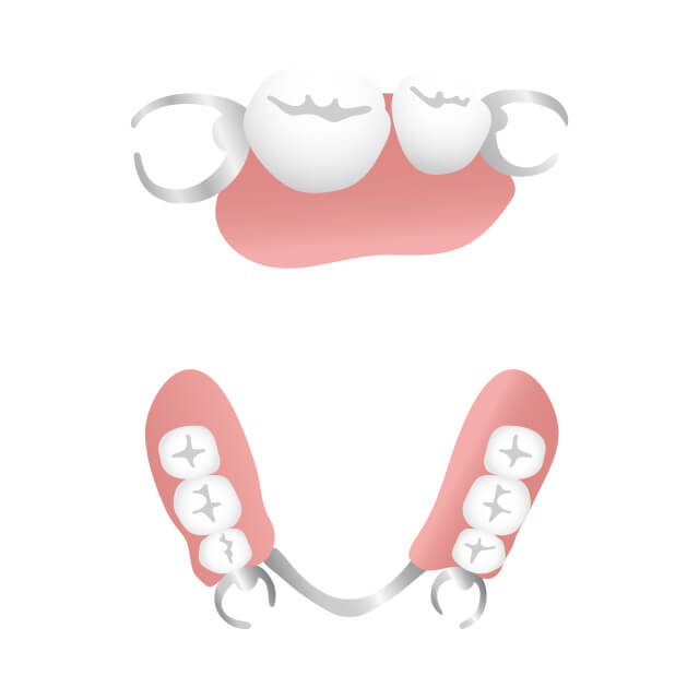 部分入れ歯（部分義歯）