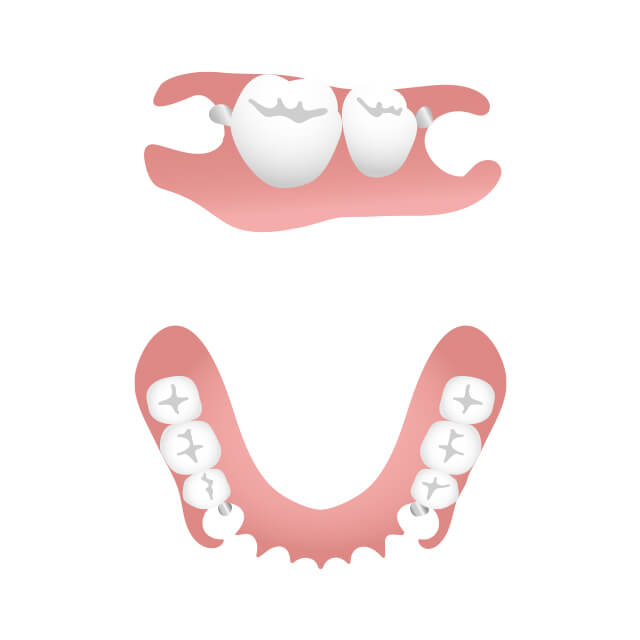 ノンクラスプデンチャー（バネのない入れ歯）